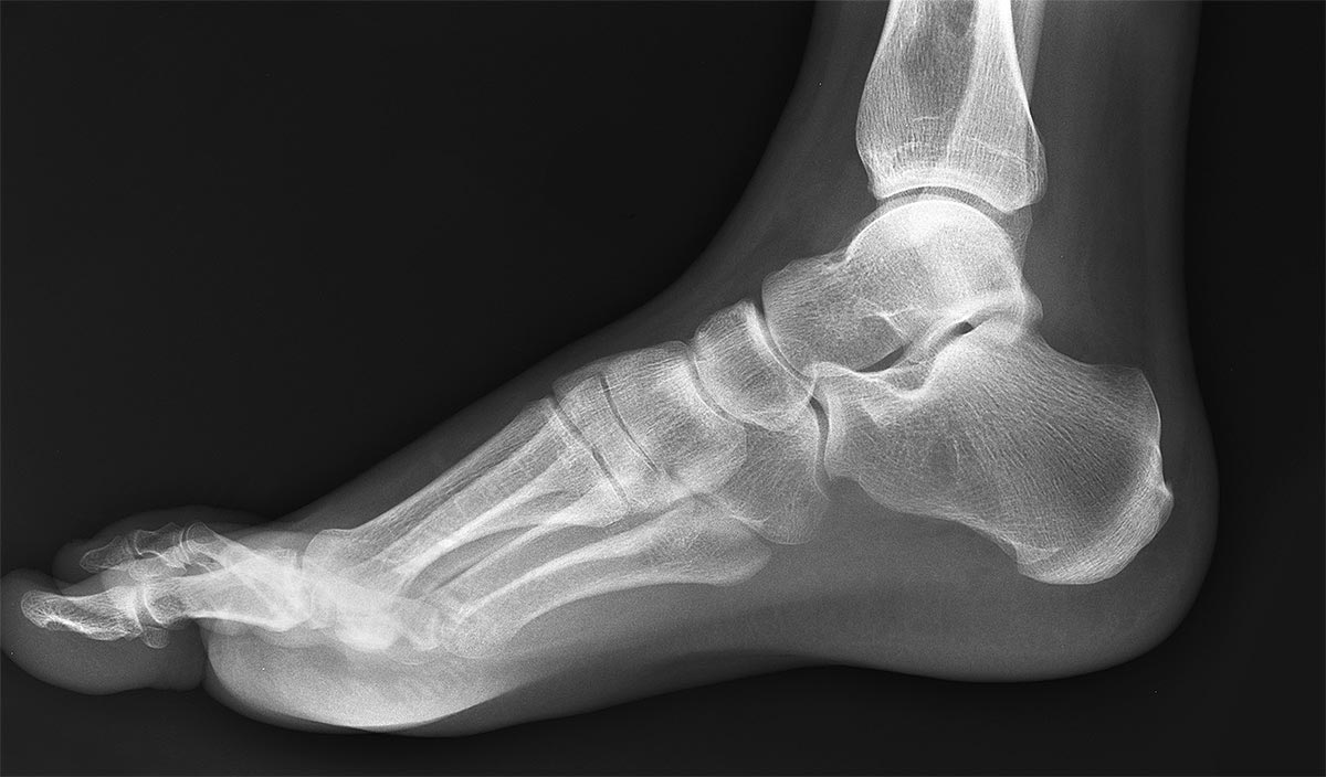 foot-xray
